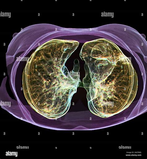 Pulmones sanos 3D color tomografía axial computarizada TAC del tórax