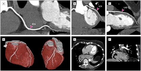 Coronary Computed Tomography Angiography Cardiology Jama Jama Network