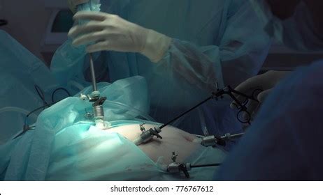 Operation Using Laparoscopic Equipment Surgeons Team Stock Photo