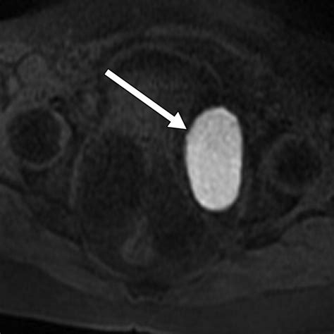 Practical Approach To Mri Of Female Pelvic Masses Ajr