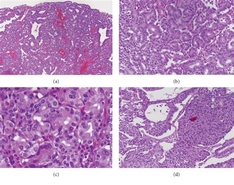 Figure 1 From Pyloric Gland Adenoma Of Gallbladder A Review Of Diagnosis And Management