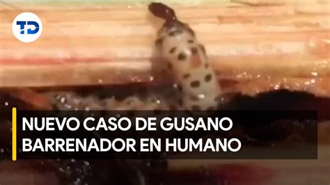 Confirman Tercer Caso De Gusano Barrenador En Humano YouTube