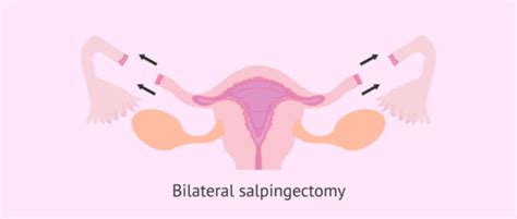 Bilateral salpingectomy