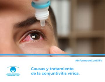 Conjuntivitis vírica estos son los tratamientos y las causas