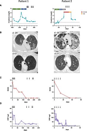 Daratumumab For The Treatment Of Refractory ANCA Associated Vasculitis