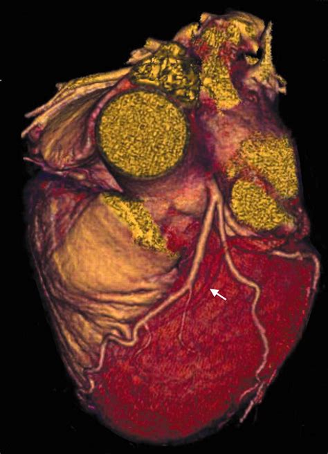 Multidetector Row Computed Tomography Imaging Congenital Coronary