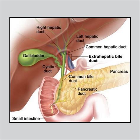 Gallbladder - Gallbladder Attack