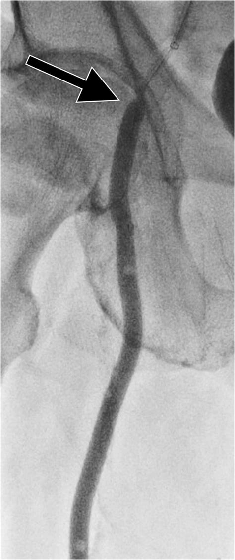 Endovascular Recanalization And Stent Graft Placement For A Chronically