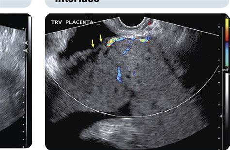 Morbidly Adherent Placenta Disorder Semantic Scholar