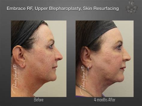 Embrace Rf New Orleans Center For Aesthetics And Plastic Surgery