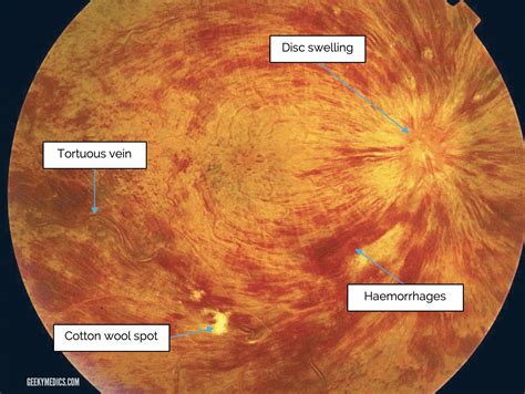 Vitreous Hemorrhage Fundoscopy