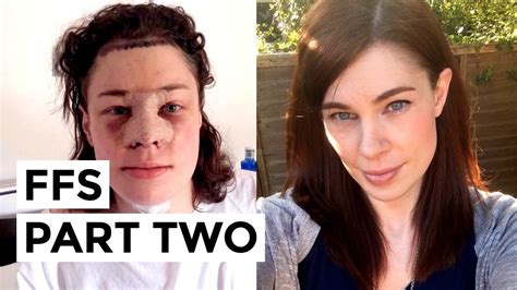 Facial Feminisation Surgery Ffs Part 2 Recovery And Results Youtube