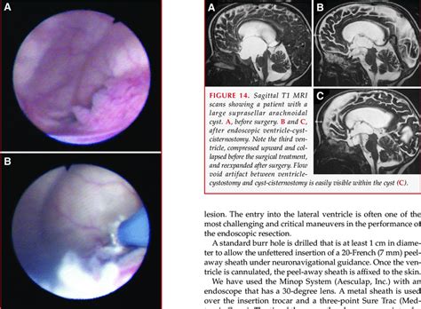 A And B Cauterization Of The Choroid Plexus In The Temporal Horn