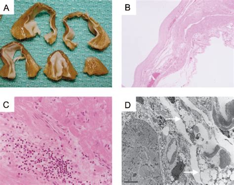 Figure From Left Ventricular Aneurysm Associated With