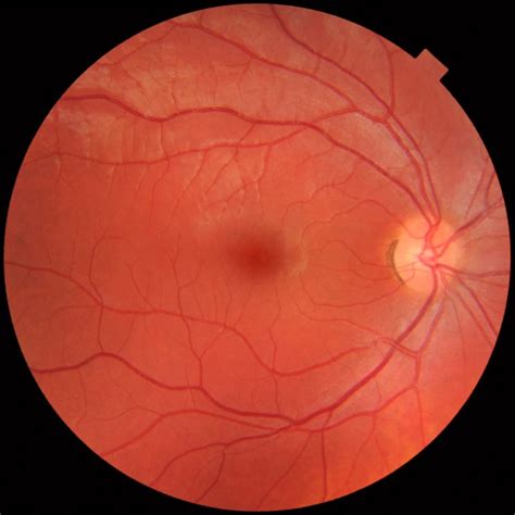 Retinografia o que é como é feito como se preparar para o exame