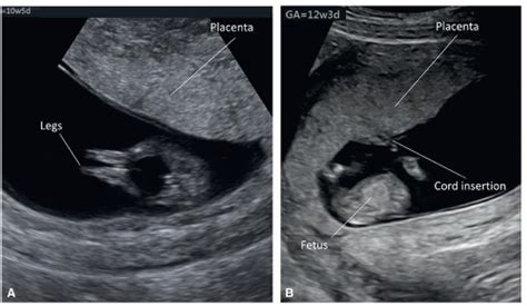 Placenta And Umbilical Cord Radiology Key