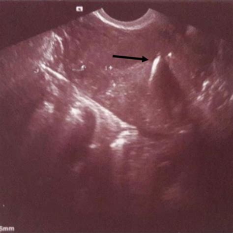transvaginal ultrasound intramyometrial iud   fragmented aspect