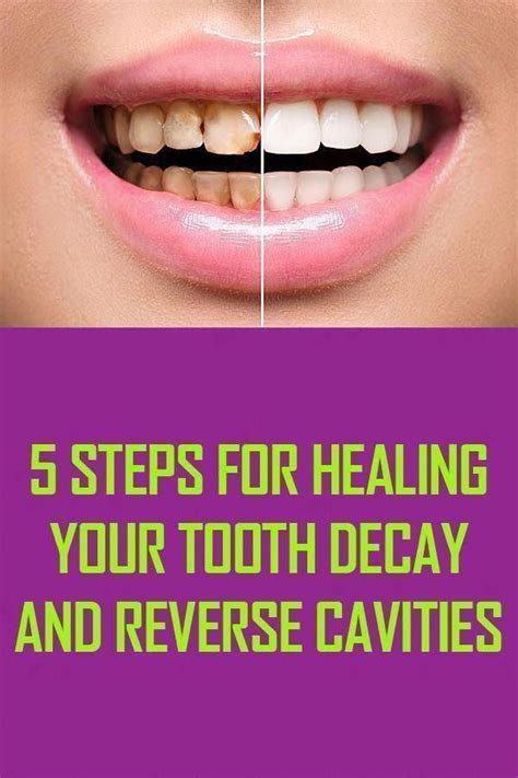 Get Rid Of Cavities And Tooth Decay Kathleen Drews Artofit