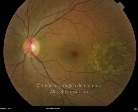 FAMILIAL DOMINANT DRUSEN – Atlas RL Eye