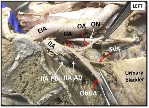 Obturator And Superior Vesical Arteries Arising From Umbilical Artery