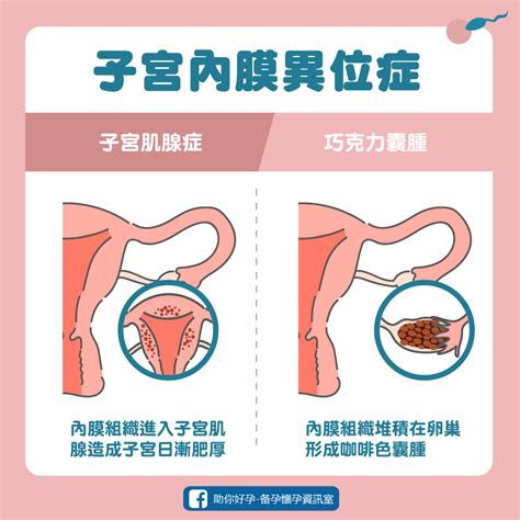 子宮後傾會引起經痛、腰痠？是否會降低懷孕機率？