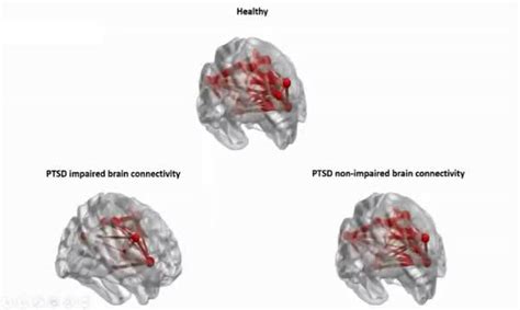 Unique Patterns Of Brain Activity Predict Tre Eurekalert