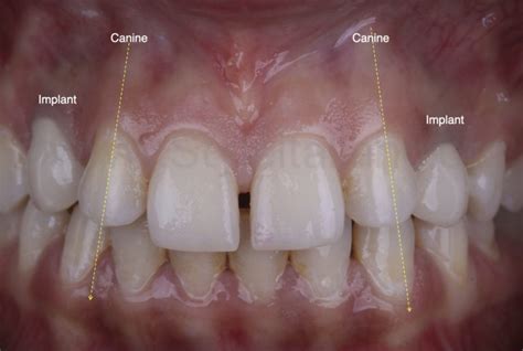 Midline Diastema Closure Using The Front Wing Technique Styleitaliano Org