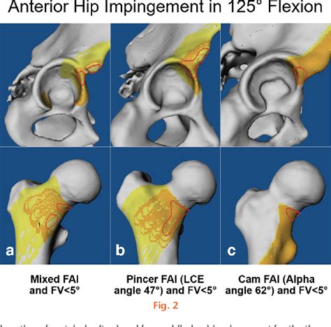 Figure From Femoral Impingement In Maximal Hip Flexion Is Anterior