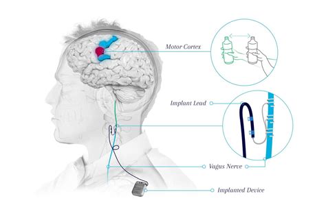 Vagus Nerve Stimulation System Approved For Post Stroke Rehabilitation Therapy