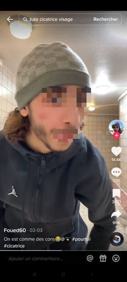 Cicatrice Francese La Nuova Pericolosa Challenge Di Tiktok Ccm