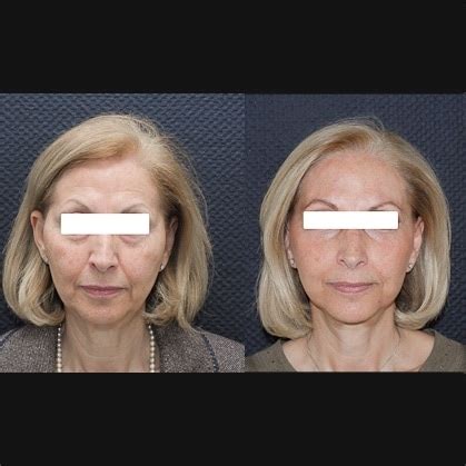 Photos avant après un lifting cervico facial