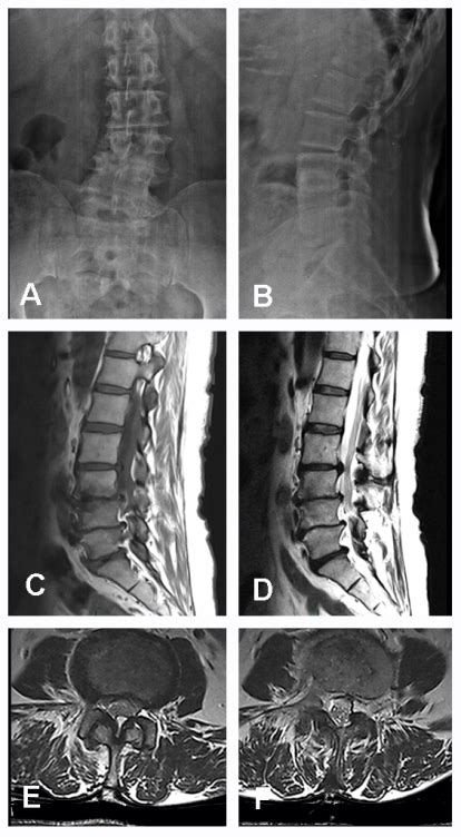 Osteoarthritis Of Lumbar Spine