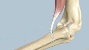 Distal Biceps Tendon Rupture Dr Grey Orthopedic Surgeon Cape Town