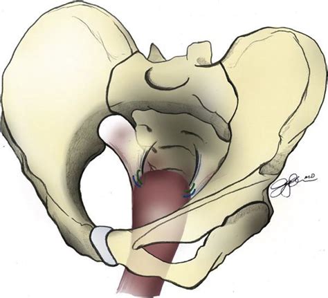 Effect Of Sacrospinous Hysteropexy With Graft Vs Vaginal Hysterectomy