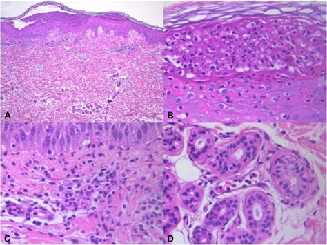 Portuguese Woman With Nlrp And Il Rn Mutations Histopathological