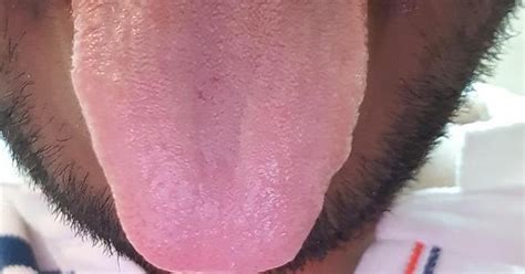 Is This Oral Hairy Leukoplakia Or Oral Thush Album On Imgur