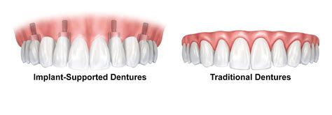 Dentures - Valdosta, GA - Advanced Dental Care