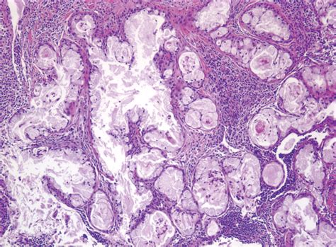 Mucoepidermoid Carcinoma Of The Parotid Gland The Mayo Clinic