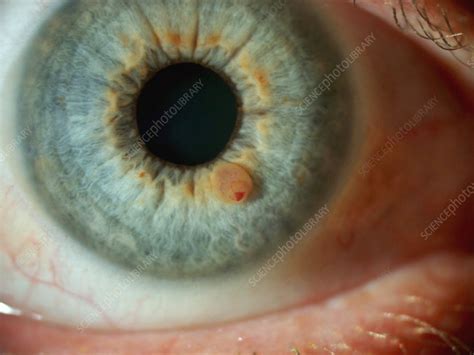 Iris Cyst