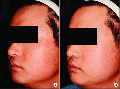 A Before Treatment Remark Able Lentigines And Dyschromia On The