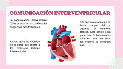 Comunicación Interventricular Genesis Martinez Udocz