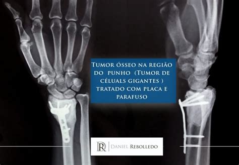 Tumor Sseo Sintomas Ao Tratamento Blog Dr Daniel Rebolledo