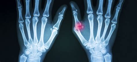 Basal Joint Arthritis Treatment San Antonio TX