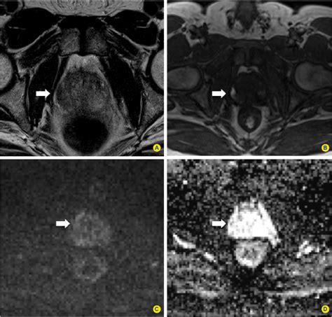 Figure From The Role Of Multiparametric Magnetic Resonance Imaging