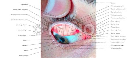 Palpebral Conjunctiva Photos Superior Eyelid Upper Eyelid Posterior