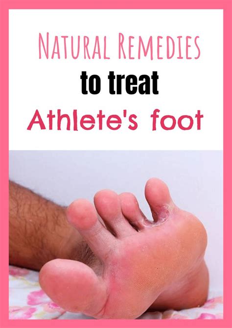 Athletes Foot 4 Natural Remedies To Treat This Fungal Infection