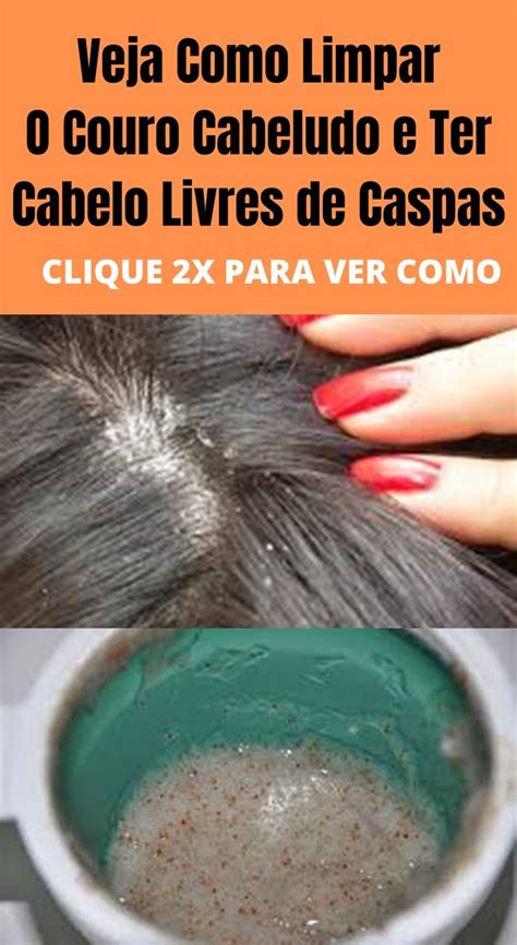 Como Evitar Perda De Cabelo Caspa Fungos Nas Unhas Em 3 Minutos Em