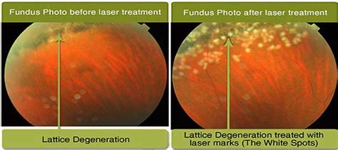 Lattice Degeneration & Retinal Detachment Risk - Preventative Treatment ...