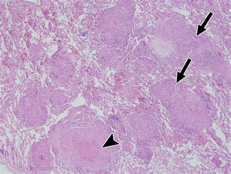 Tuberculosis Lungs Histology