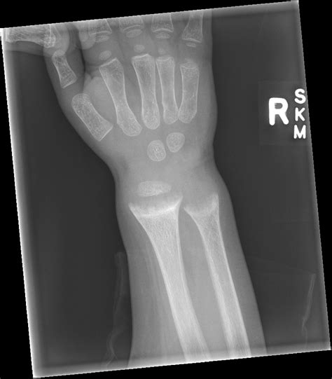 Rickets Disease X Rays